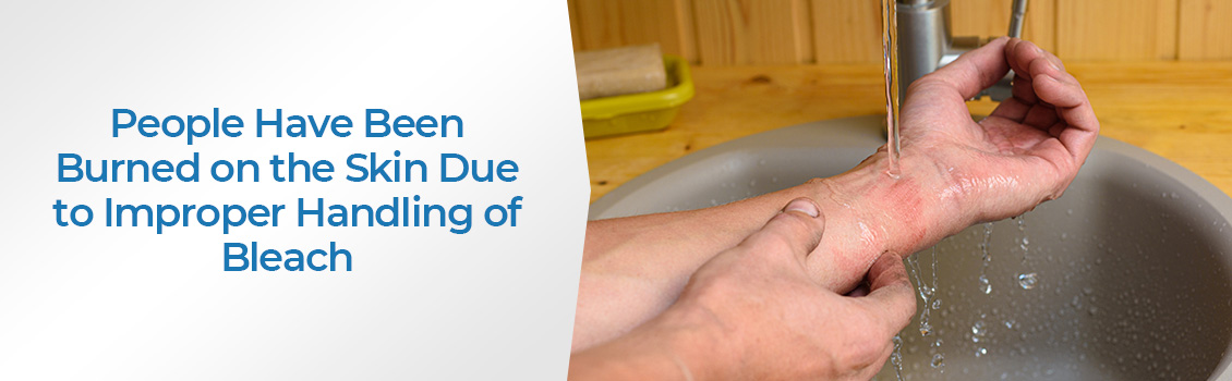 Hands Under a Faucet Nursing Burns Caused by Improper Handling of Bleach